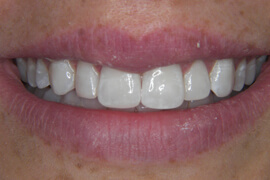 After receiving cosmetic Dental bonding in Nashville