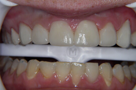 after receiving porcelain veneers & crowns