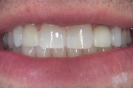After receiving a dental implant crown restoration & a porcelain veneers in Nashville