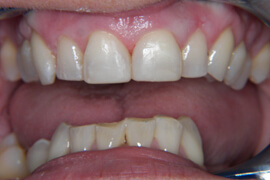 after receiving cosmetic bonding treatment