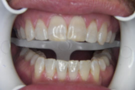after receiving laser Teeth whitening treatment