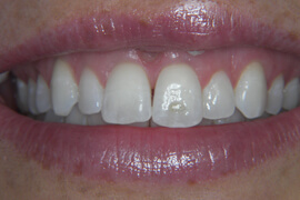 Before cosmetic dentistry treatment