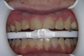 Before receiving Porcelain veneers