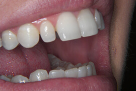before treatment with Green Hills Dental Center' cosmetic dentist