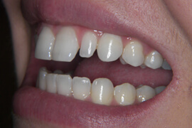 after receiving composite dental bonding