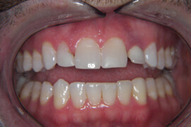 Before receiving restorative & cosmetic dental services