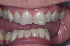 Before treatment with Nashville cosmetic dentist