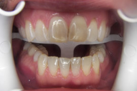 Before receiving in-office teeth whitening