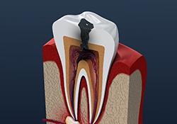 3D render of a decayed tooth