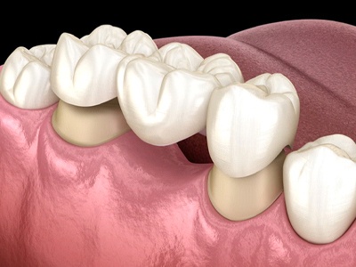 diagram of dental bridge being placed in mouth 