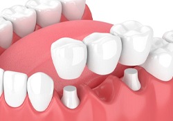 diagram of dental bridge being placed in mouth 