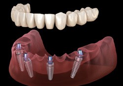 3D illustration of all-on-4 dentures
