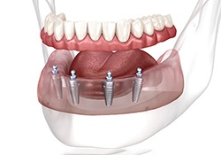 implant option representing the cost of dentures in Green Hills