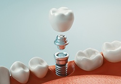 a computer illustration showing the different parts of a dental implant