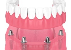 implant dentures on bottom arch