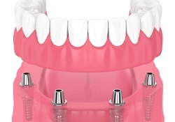 implant dentures on bottom arch