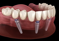 implant dentures on bottom arch 