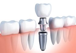 diagram of dental implant post, abutment, and crown 