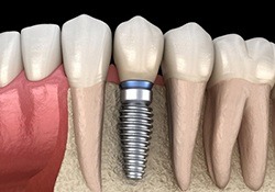 dental implant post in the bottom jaw 