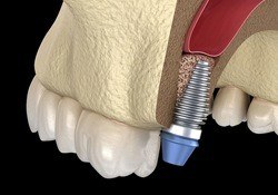 dental implant post in the upper jaw