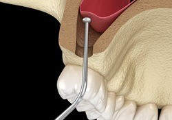 dentist performing sinus lift procedure