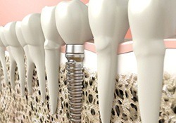 single dental implant in a jawbone 