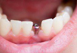dental implant post without crown in a person’s mouth 