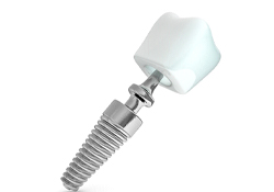 dental implant post, abutment, and crown 