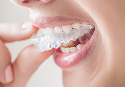 Women putting in Invisalign tray