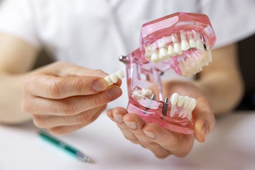 Hands holding sample jaw with 2 implants and a sample dental bridge