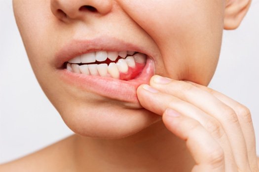 Woman pulling down lower lip to reveal dark red gums