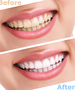 before and after whitened smile