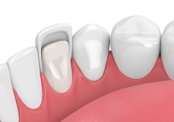 veneers next to teeth