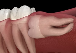 Impacted wisdom tooth