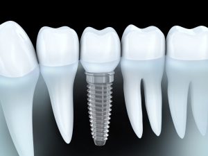 dental implants in Nashville