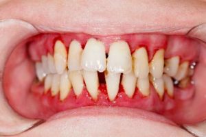 Close up view of unhealthy gums