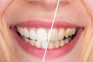 teeth whitening before and after