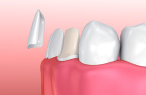 Porcelain veneers graphic