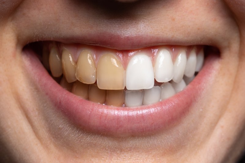 person smiling with different colored teeth in Green Hills