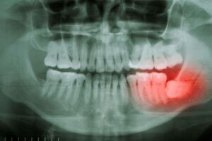Sideways wisdom tooth highlighted on dental X-ray